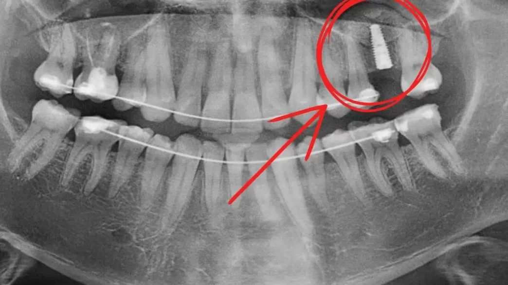 implant dentar, adiție de os, experiență, Dent Estet Ploiești, doctor Mihai Ioan, doctor implantolog