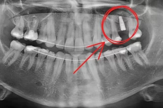 implant dentar, adiție de os, experiență, Dent Estet Ploiești, doctor Mihai Ioan, doctor implantolog